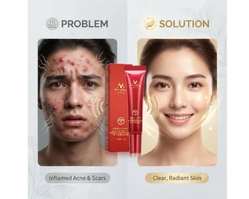 MeiYanQiong Herbal Acne Treatment Face Cream 15ml